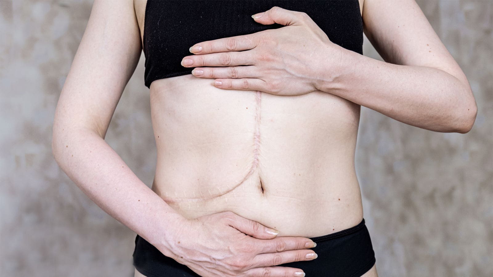Liver Transplant Sex Disparities Vanish With Living-Donor Access | MedPage Today